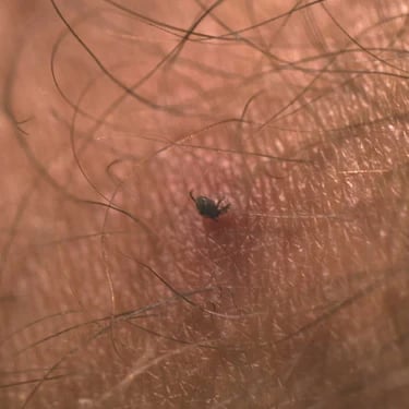 Tick Remover Tool
